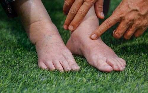 Ritenzione idrica nelle caviglie