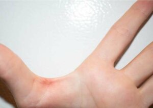 Bolla provocata dall'attrito.