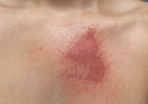 Ustione alla mano.
